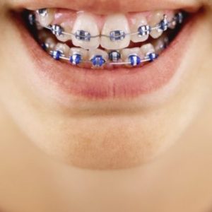 Denti di un bambino con l'apparecchio