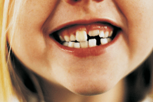 Una bambina a cui sono caduti i denti da latte